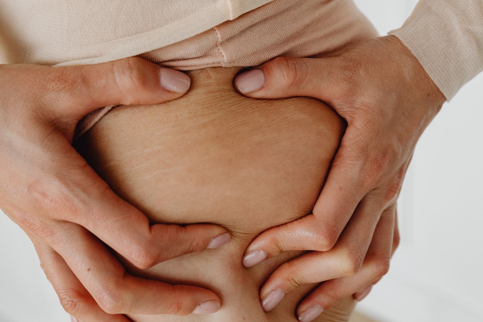 Stretch marks on the stomach before microneedling treatment