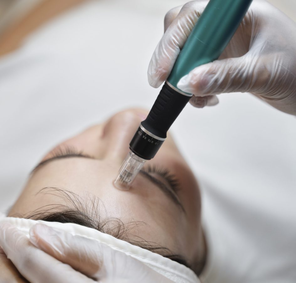 person-getting-micro-needling-beauty-treatment